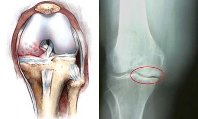 artroza genunchiului cu raze X