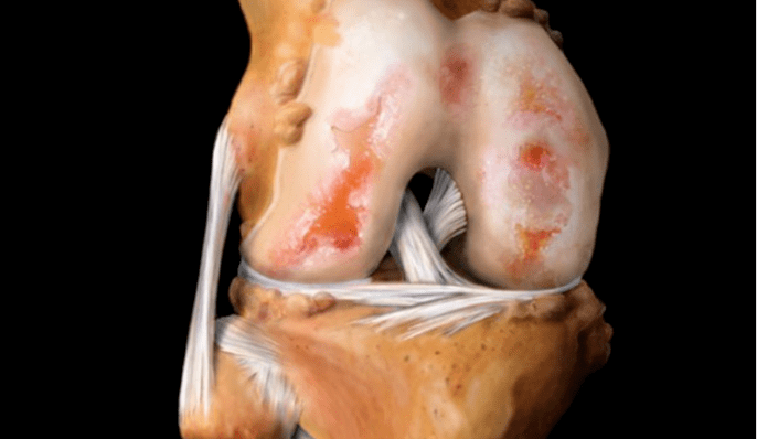 osteoartrita articulației genunchiului