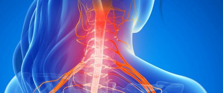 Comprimarea vaselor măduvei spinării în osteocondroza coloanei cervicale
