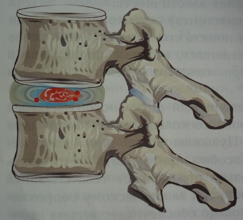 Deteriorarea nucleului pulpos al discului intervertebral în prima etapă a osteocondrozei cervicale