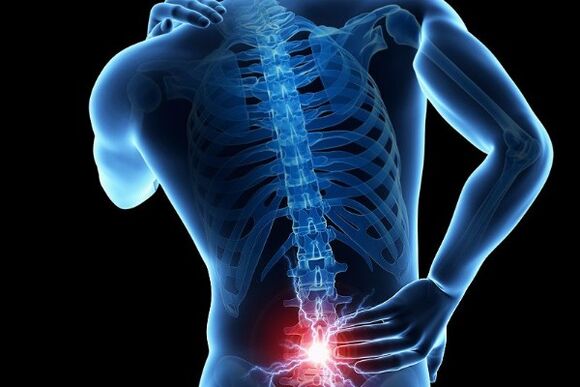 Durerea acută de spate este un simptom al deplasării discurilor intervertebrale