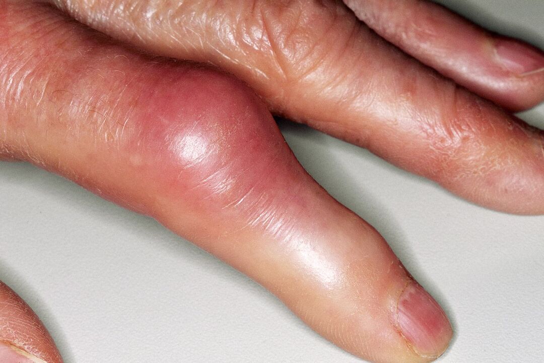 Umflare, deformare a articulației degetelor și durere acută după leziune