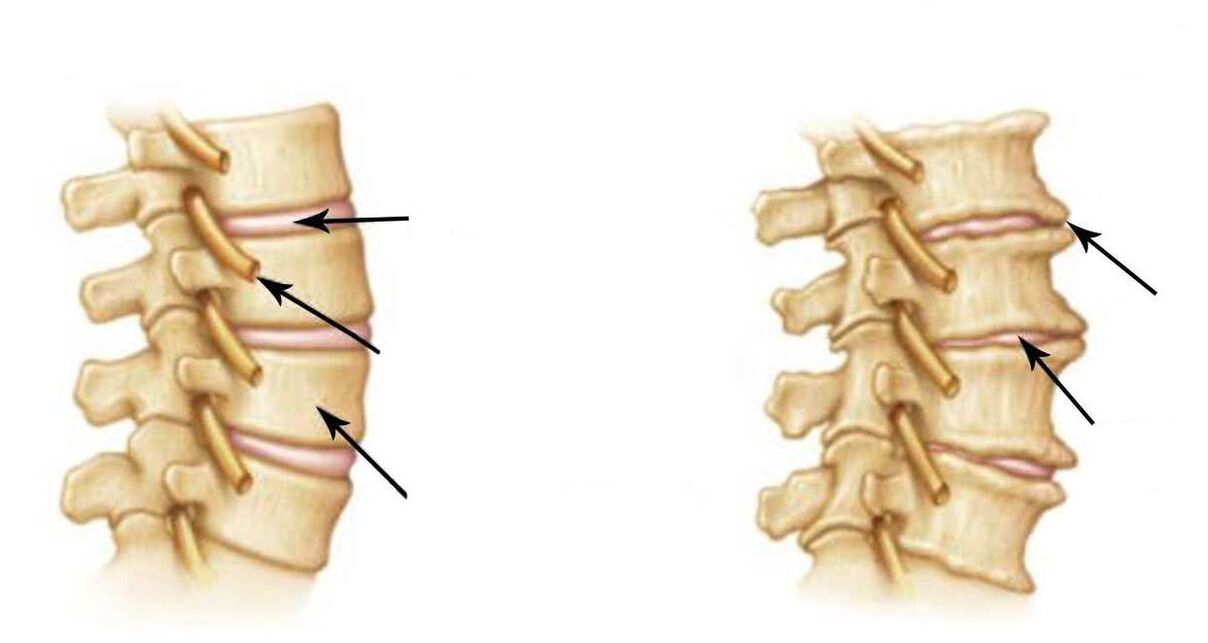 coloana vertebrală sănătoasă și bolnavă