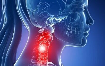 Osteochondroza gâtului