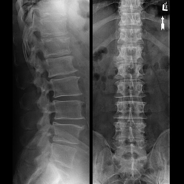Sncing of the Lovel cu osteochondroză