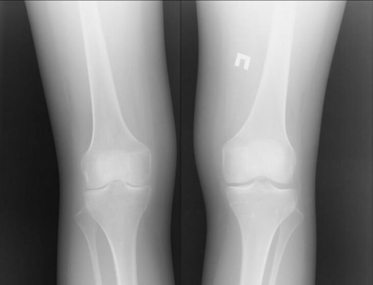 Radiografie a genunchilor afectați de arttroză