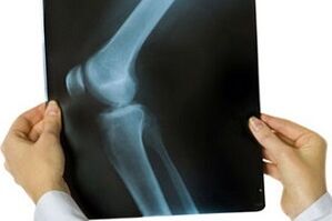 artroza articulației genunchiului la radiografie