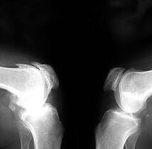 Artroza la radiografie