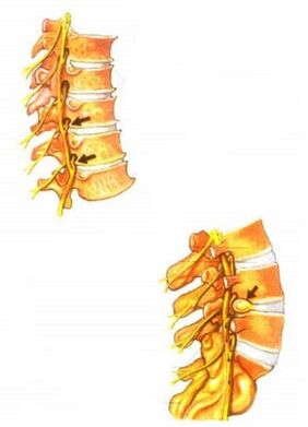 ilustrare a osteocondrozei spinale