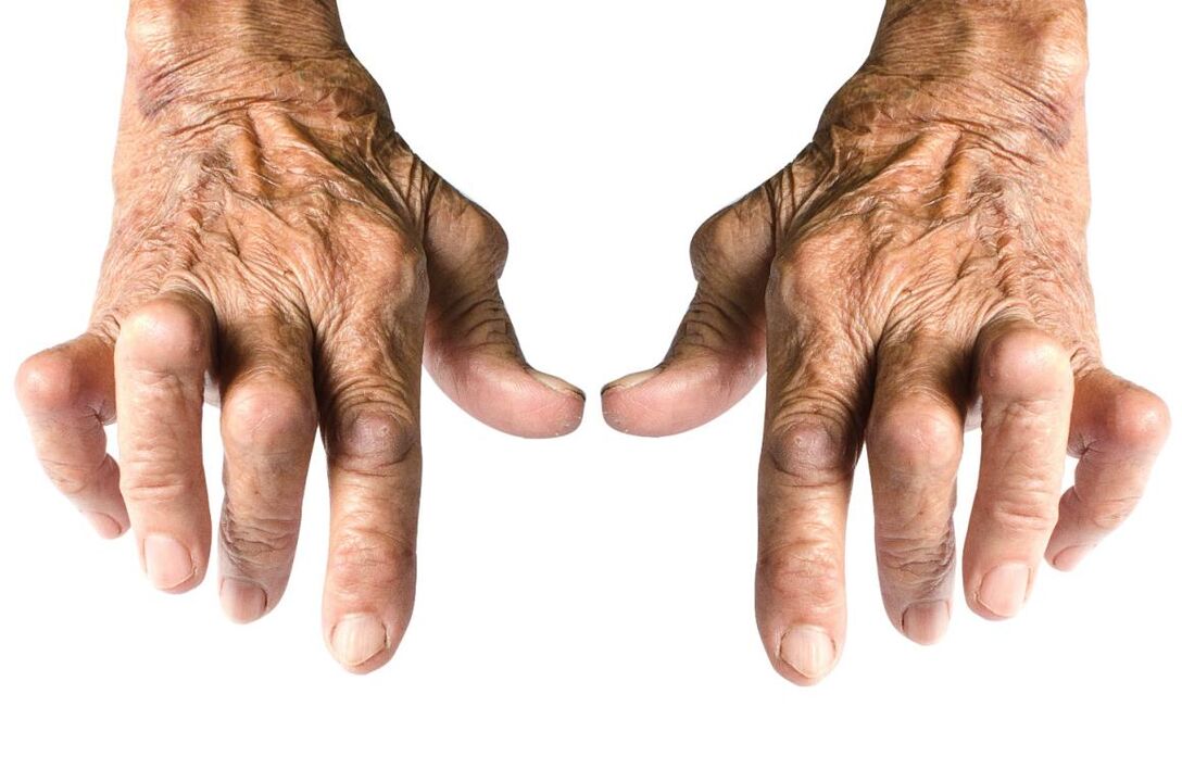 semne de artrită - deformare articulară